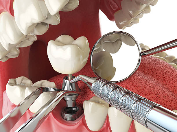 Best Emergency Root Canal Treatment in Dianapolis, IN